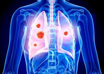 عادة خطيرة تؤدي إلى زيادة كبيرة في إصابات السرطان