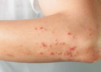 ما أسباب ظهور البقع الحمراء على الجسم؟