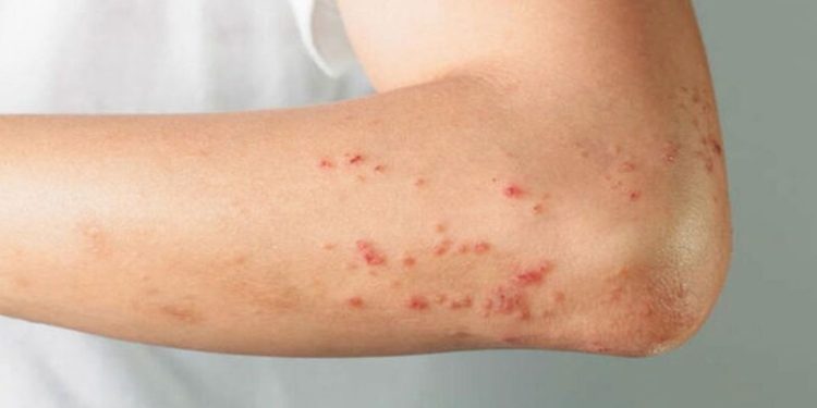 ما أسباب ظهور البقع الحمراء على الجسم؟