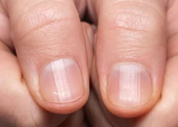ما هي دلالة الخطوط على أظافرك؟