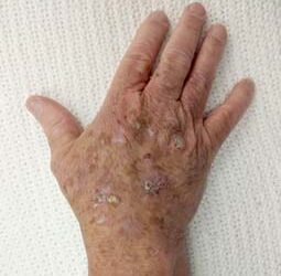 ما أسباب ظهور البقع الحمراء على الجلد وما مدى خطورتها؟